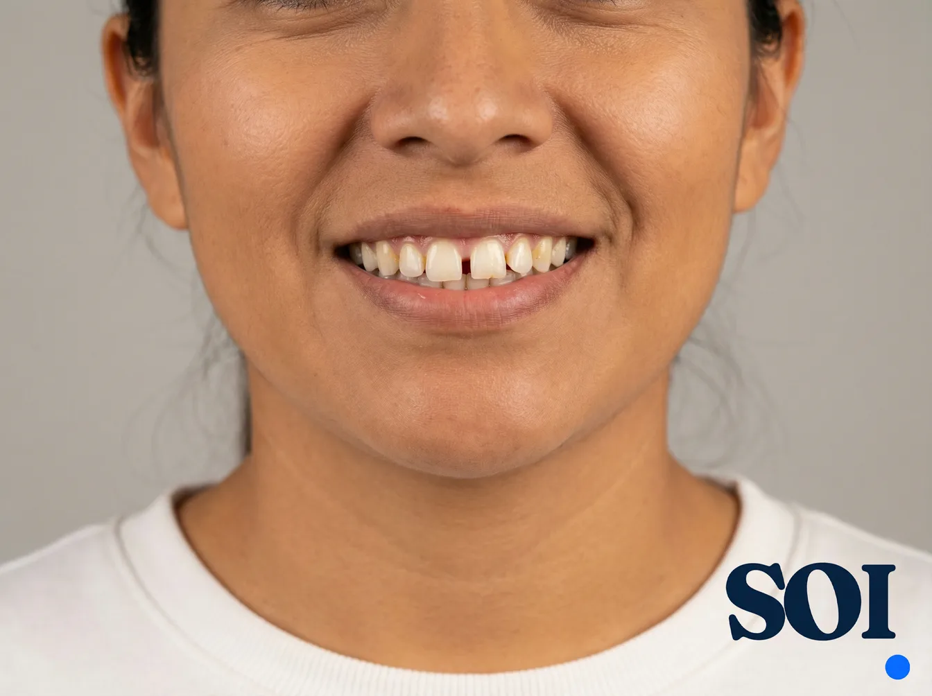 Antes del tratamiento con carillas dentales — SOI Quito